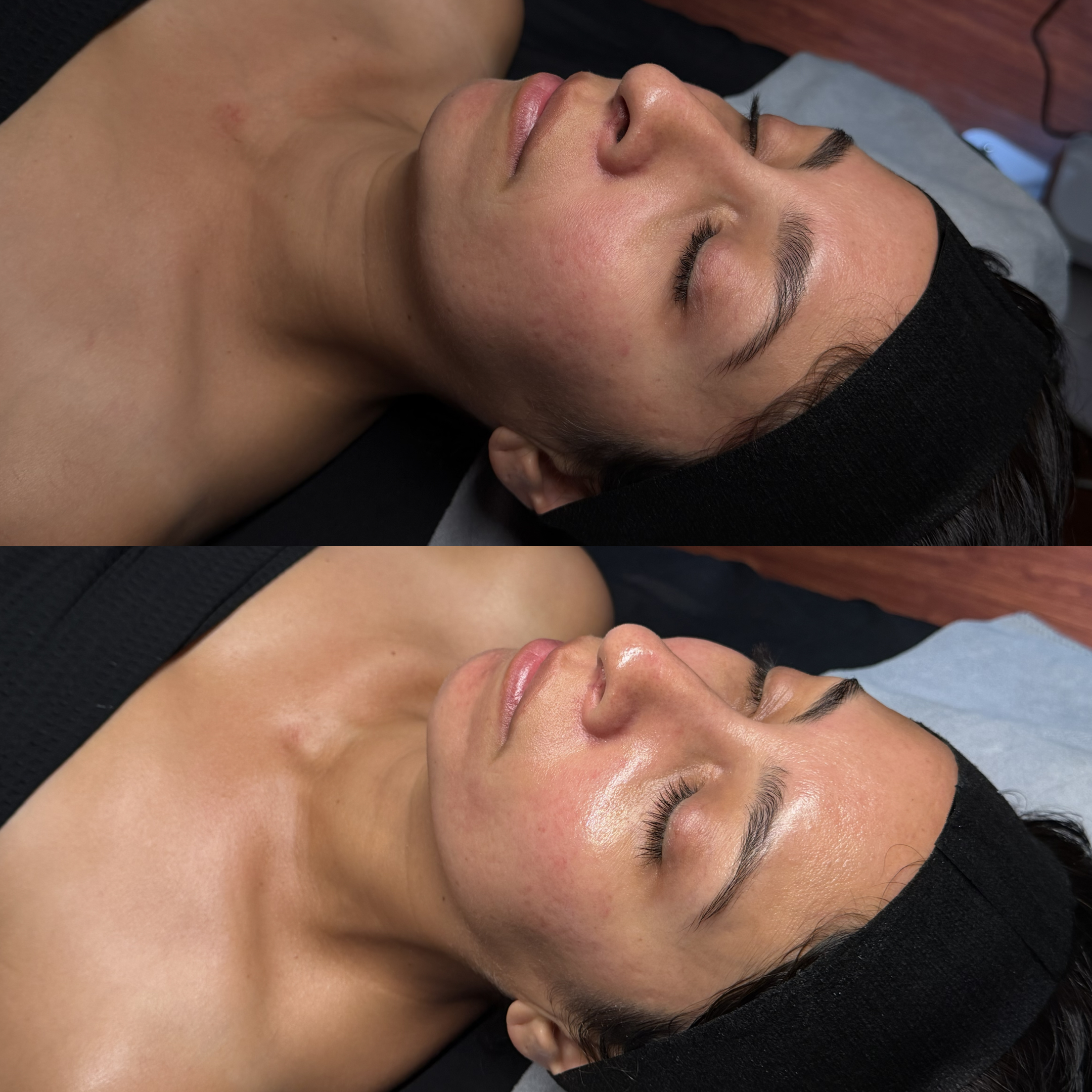Mission Valley San Diego HydroFacial before and after skin results