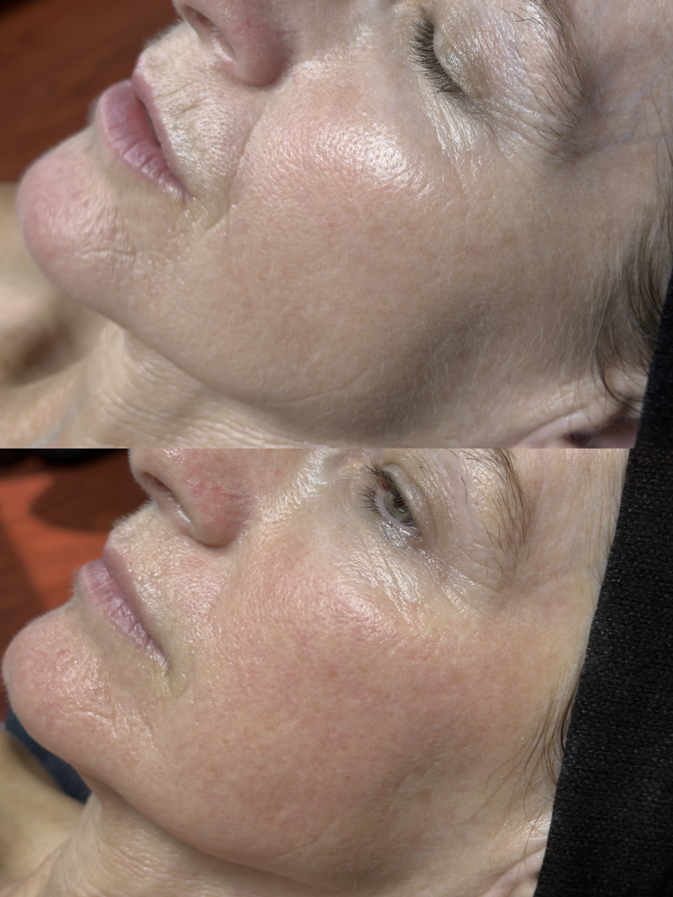 Microchanneling facial before and after results in San Diego