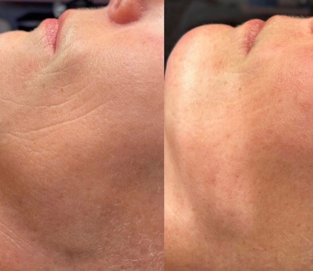 Procell microchanneling facial treatment at Jazlyn Skin Lounge